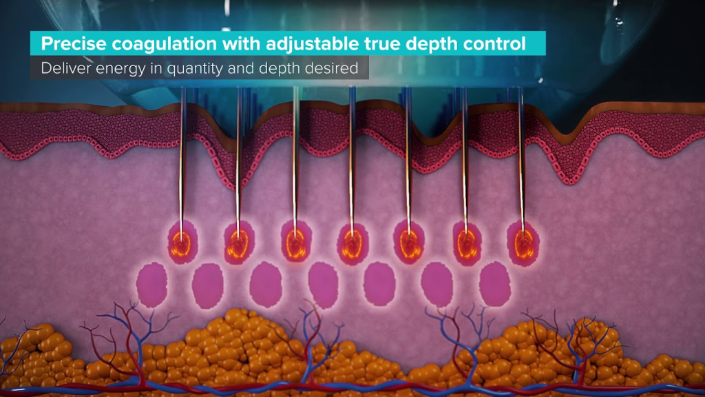 Microneedling depth diagram