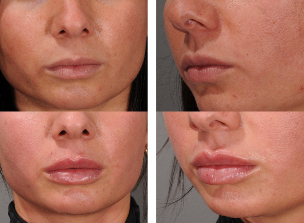 Juvederm filler to lips by Tori Grasta, RN injector