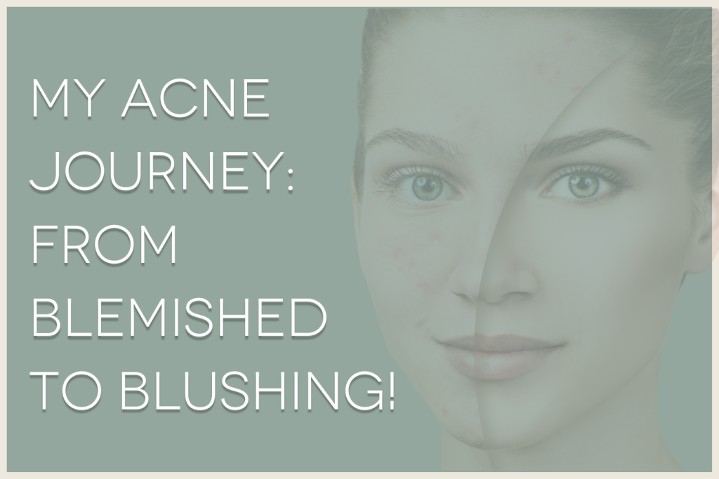 My Acne Journey: From Blemished to Blushing