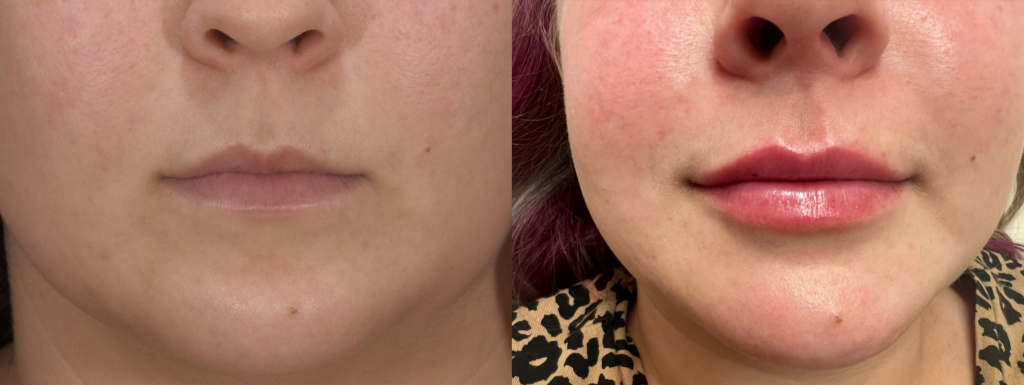 Lips with dermal filler injection before and after