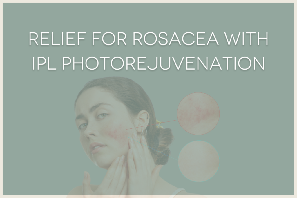 Relieve for Rosacea with IPL Photorejuvenation